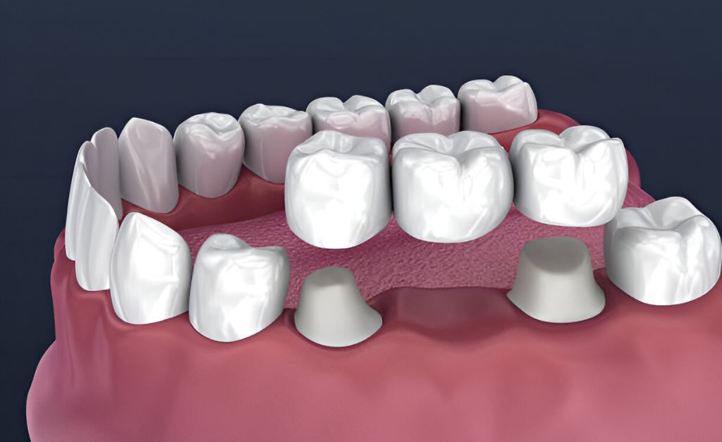 dental crowns and bridges near you in coquitlam