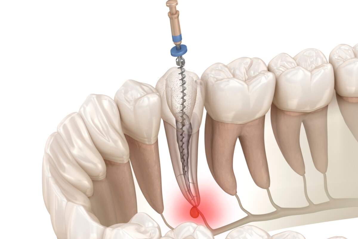 understanding the 3 stages of root canal treatment